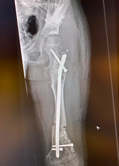 Her ser ein korleis metallstonga og fester ser ut inne i foten. Nede på lårbeinet ser ein tydeleg kor det er knekt. Røntgenfoto: Rikshospitalet.